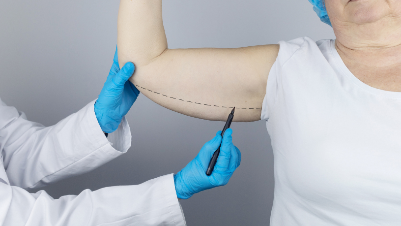 Lifting de coxas e braços: Firmeza e autoconfiança de volta 32 Resultados naturais e recuperação rápida: Milton Seigi Hayashi fala sobre a evolução dos liftings corporais.