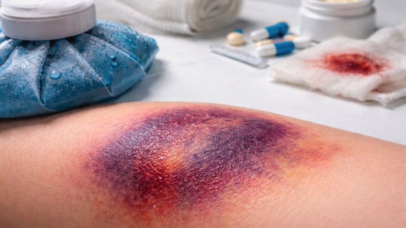 Hematoma e seroma: O que são e como podem ser tratados? Saiba com Haeckel Cabral Moraes 32 Haeckel Cabral Moraes